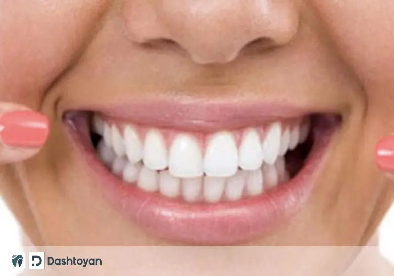 Dental prosthetics